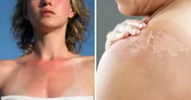 7 طرق فعالة لعلاج حروق الشمس وشفاء بشرتك سريعاً